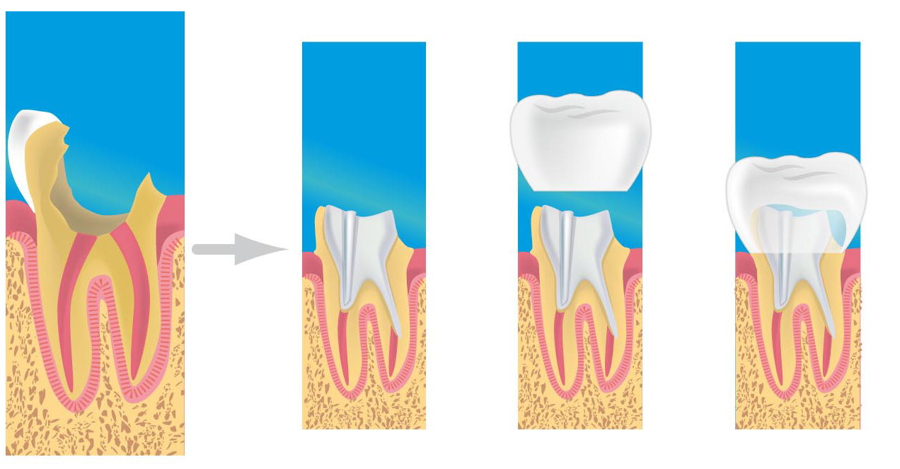dentiste bondy prothèses