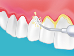 parodontie dentiste bondy 