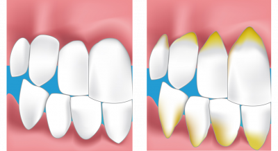 dentiste bondy soin des gencives